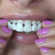 Snap-on-Veneer